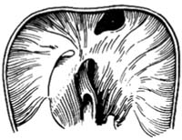 示意图2:胸骨旁裂孔